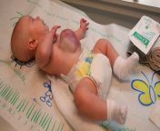 ht omphalocele baby jef 120109 wg.jpg from born ob bolly