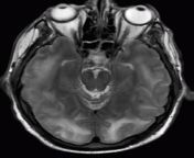 posterior reversible encephalopathy syndrome mri.jpg from pres