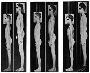 330px variations of the height of three boys from 12yo to the end of their growth spurt.jpg from puberty penis