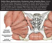 pelvic floorpain .jpg from painfull mms