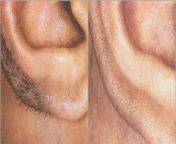 before and after ears laser hair removal.jpg from face shaving before laser hair removal less growth i am rafia