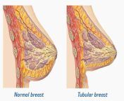 tubular breast.jpg from 12 age boob