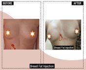 breast fat injecion india.jpg from breast injection