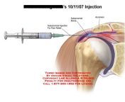 subacromial bursa injection technique.jpg from indian shoulder injection