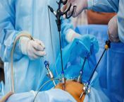 laparoscopic surgery image 525787207 scaled uai 2560x1440 1 1920x960.jpg from indian aunty uterus operation