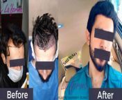 best fue without head shave hair transplant in pakistan and lahore.jpg from xxxقw bollywoo pakistan sex pashto comy amrpit shave and hair chut pan nighty dress girl sexister nahate hue desi big ass aunty hidden camw dvd com mallu aunty sex dhaka video free download