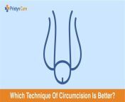 which technique of circumcision is better 768x384.jpg from dausa sex video tamiak seal phtos