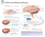 understanding epilepsy anatomical wall chart.jpg from epilepsy