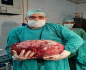 nintchdbpict000484226610.jpg from indian aunty uterus operation