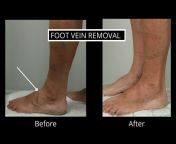 foot vein removal.jpg from 2016 feet veiny