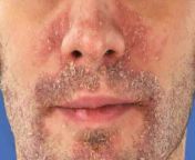 dry patches on face psoriasis.jpg from not on face