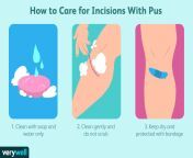 what to do about pus from a wound or incision 315731482 022d13fe11264c1a939743ce69045257.jpg from only pus