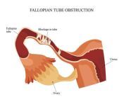 fallopian tube blockage.jpg from tubal