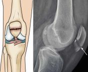 displaced patella fracture.jpg from gorilla puncher fractures patella and still performs enjoy the show