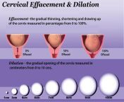 cervix effacement and dilatation.jpg from cervex