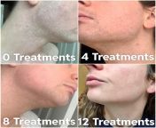 5paxeo54fs5b1.jpg from face shaving before laser hair removal less growth i am rafia