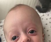 crouzon syndrome causes abnormalities in the shape of the head and face and may be apparent at birth image credit katevuk 2018 april 13 jpgw1155 from huge facial premature unexpected