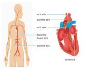 1680 ascending aortic aneurysm anatomy 1296x728 body jpgw1155h1528 from wwwaorata