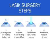 lasik surgery steps 678x446 giffmjpgq80 from ljsij erfye