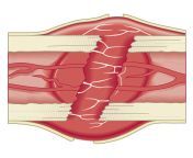 cross section biomedical illustration of bone repairing itself with clot forming to seal broken blood vessels and fibrous tissue forming to replace the clot dorling kindersley.jpg from 1st time seal broken blood sex videos in hd