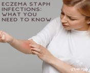 eczema staph infectionswhat you need to know min 1.png from sitaph