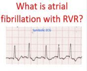 what is atrial fibrillation with rvr.jpg from rwhvr gwow