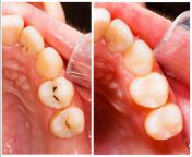 white tooth filling.jpg from filling