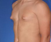 gynecomastia type 1s min.jpg from best puffy nipples
