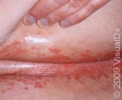 candidiasis 5416 lg.jpg from pusyeasty