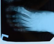 xray of toes foot on xray bone research picture id1165646903k6m1165646903s170667aw0hgdpxjcufznajdtd9ndhk1jgftohi8iuvtcsebe2ju1o from Ã¡ÂÂuncle gangbangupasana xray
