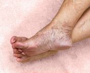 varicose veins on legs with feet in senior woman 732x549 thumbnail.jpg from 2016 feet veiny