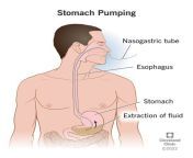 24587 stomach pumping from tamil gails saressex