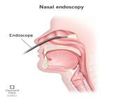 22156 nasal endoscopy from nasal
