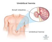 umbilical hernia from sex mom fat