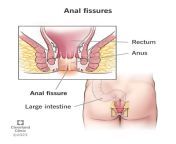 13177 anal fissures from anus