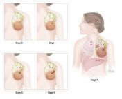 breast cancer stages illustration.jpg from breast feid