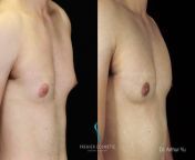 gomez frank breast lift and nipple lift model 45logo 1024x648.jpg from 根治的乳房切除術 prov