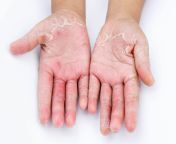 dry peeling hands 1536x1024.jpg from hand skin goa