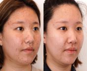 laser acne before after p1 3 jpgv1641320069 from before aft