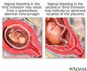 17137.jpg from woman bleeding vagina