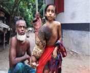 bangladeshi girl with tree man disease jpgimpolicymedium resizew1200h800 from bangla and man beg com tamil sex of chair xxx
