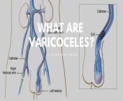 what are varicoceles.jpg from varicocele