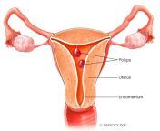 uterine polyps.jpg from lolyp