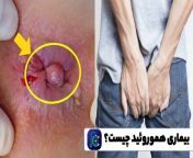 hemorrhoids 1.jpg from بواسیر