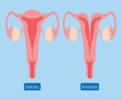 what is a bicornuate uterus.jpg from জরায়ু তে বীর্য যাওয়া ভিডিও