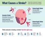 stroke causes graphic.jpg from vae strokes