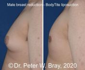 image10 surgical male male breast reduction jpeg from breast surgery