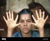 hexadactyly indian girl with six fingers in hands congenital malformation ce76bn.jpg from indian fingers