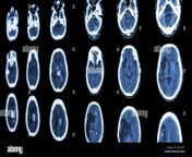 film ct scan of brain show ischemic stroke and hemorrhagic stroke edthp1.jpg from india blue filmct